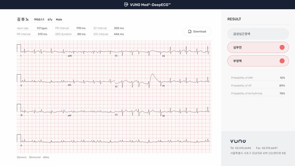 뷰노메드 딥ECG™는 딥러닝을 기반으로 심전도(ECG) 데이터를 분석해 심부전증, 심근경색증, 부정맥을 검출하는 소프트웨어형 의료기기 제품 (뷰노 제공)